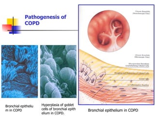 Bronchial epitheliu
m in COPD
Hyperplasia of goblet
cells of bronchial epith
elium in COPD.
Pathogenesis of
COPD
Bronchial epithelium in COPD
 
