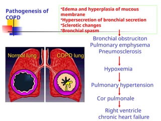 Pneumosclerosis Comprehensive Overview of Chronic Obstructive Pulmonary Disease (COPD ...