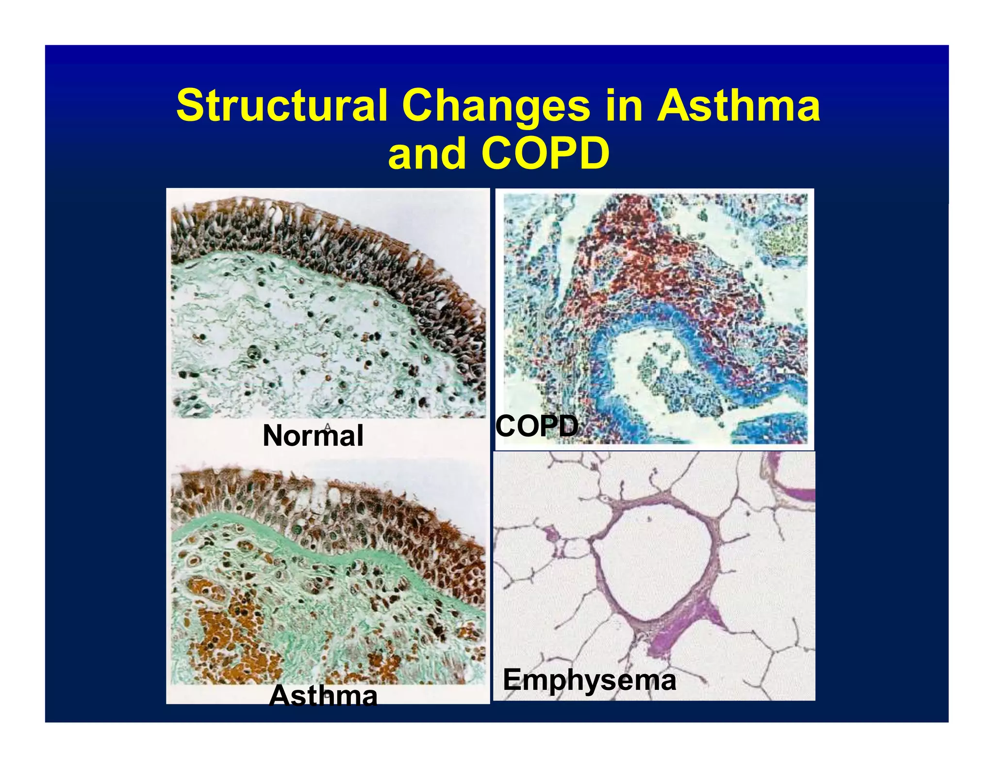 Structural Changes in Asthma
and COPD
Normal COPD
Asthma
Emphysema
 