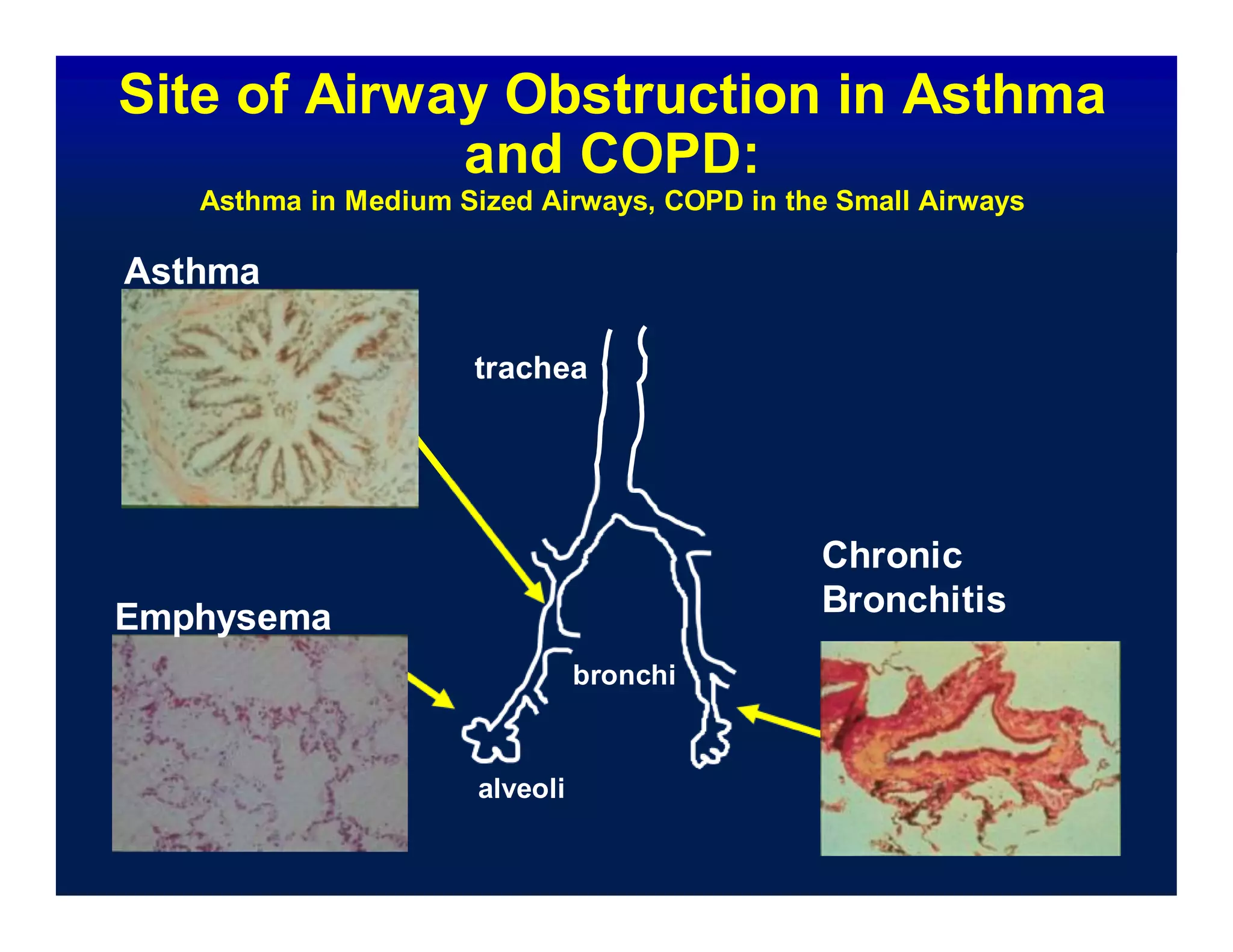 Site of Airway Obstruction in Asthma
and COPD:
Asthma in Medium Sized Airways, COPD in the Small Airways
Asthma
trachea
Emphysema
bronchi
Chronic
Bronchitis
alveoli
 