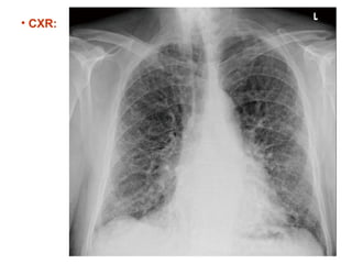 • CXR:
 