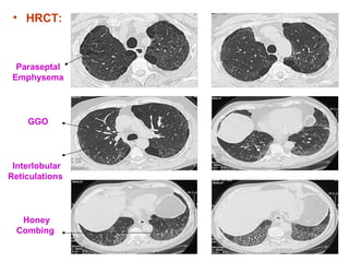 • HRCT:
Paraseptal
Emphysema
Interlobular
Reticulations
Honey
Combing
GGO
 