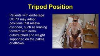 Tripod Position
Patients with end-stage
COPD may adopt
positions that relieve
dyspnea, such as leaning
forward with arms
outstretched and weight
supported on the palms
or elbows.
 