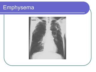 Emphysema
 