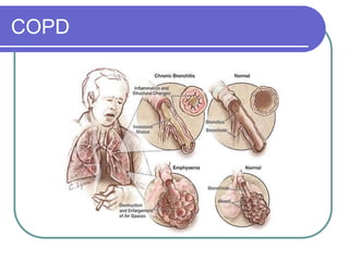 COPD
 