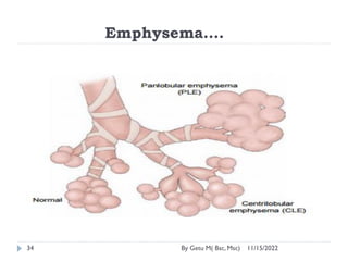 Emphysema….
11/15/2022
By Getu M( Bsc, Msc)
34
 