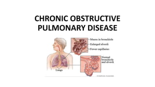 CHRONIC OBSTRUCTIVE
PULMONARY DISEASE
 
