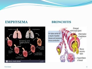 EMPHYSEMA BRONCHITIS
6/17/2020 17
 