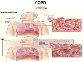 COPD
Overview
 