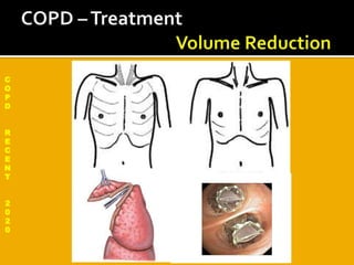 C
O
P
D
R
E
C
E
N
T
2
0
2
0
 