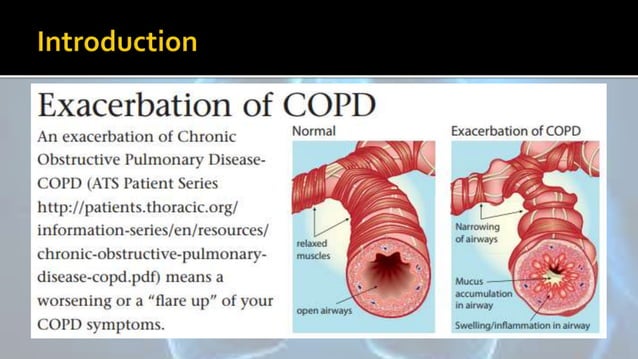 COPD: Management of Acute Exacerbation | PPTX