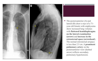  The posteroanterior (A) and
lateral (B) chest x-rays of a 71-
year-old female with emphysema
show increased lung volumes
with flattened hemidiaphragms
on the lateral examination
(arrow) and increase in the
retrosternal space (arrowhead).
The normal retrosternal airspace
is less than 2.5 cm. A prominent
pulmonary artery on the
posteroanterior view (dashed
arrow) reflects secondary
pulmonary hypertension.
 