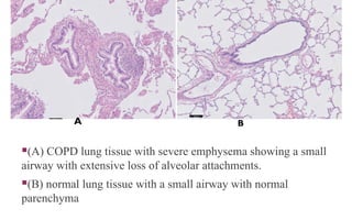 COPD NORMAL LUNG
TISSUE
(A) COPD lung tissue with severe emphysema showing a small
airway with extensive loss of alveolar attachments.
(B) normal lung tissue with a small airway with normal
parenchyma
A B
 
