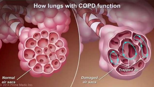 COPD(chronic obstructive pulmonary disease) ppt slideshare | PPTX