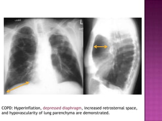 COPD: Hyperinflation, depressed diaphragm, increased retrosternal space,
and hypovascularity of lung parenchyma are demonstrated.
 