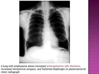A lung with emphysema shows increased anteroposterior (AP) diameter,
increased retrosternal airspace, and flattened diaphragm on posteroanterior
chest radiograph
 