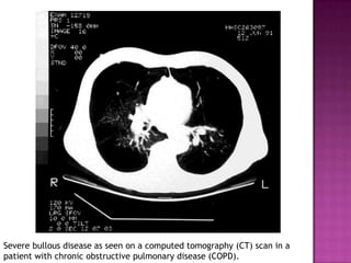 Severe bullous disease as seen on a computed tomography (CT) scan in a
patient with chronic obstructive pulmonary disease (COPD).
 