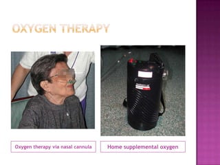 Oxygen therapy via nasal cannula   Home supplemental oxygen
 