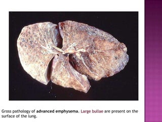 Gross pathology of advanced emphysema. Large bullae are present on the
surface of the lung.
 