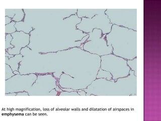 At high magnification, loss of alveolar walls and dilatation of airspaces in
emphysema can be seen.
 