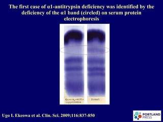 The first case of α1-antitrypsin deficiency was identified by the
deficiency of the α1 band (circled) on serum protein
electrophoresis
Ugo I. Ekeowa et al. Clin. Sci. 2009;116:837-850
 