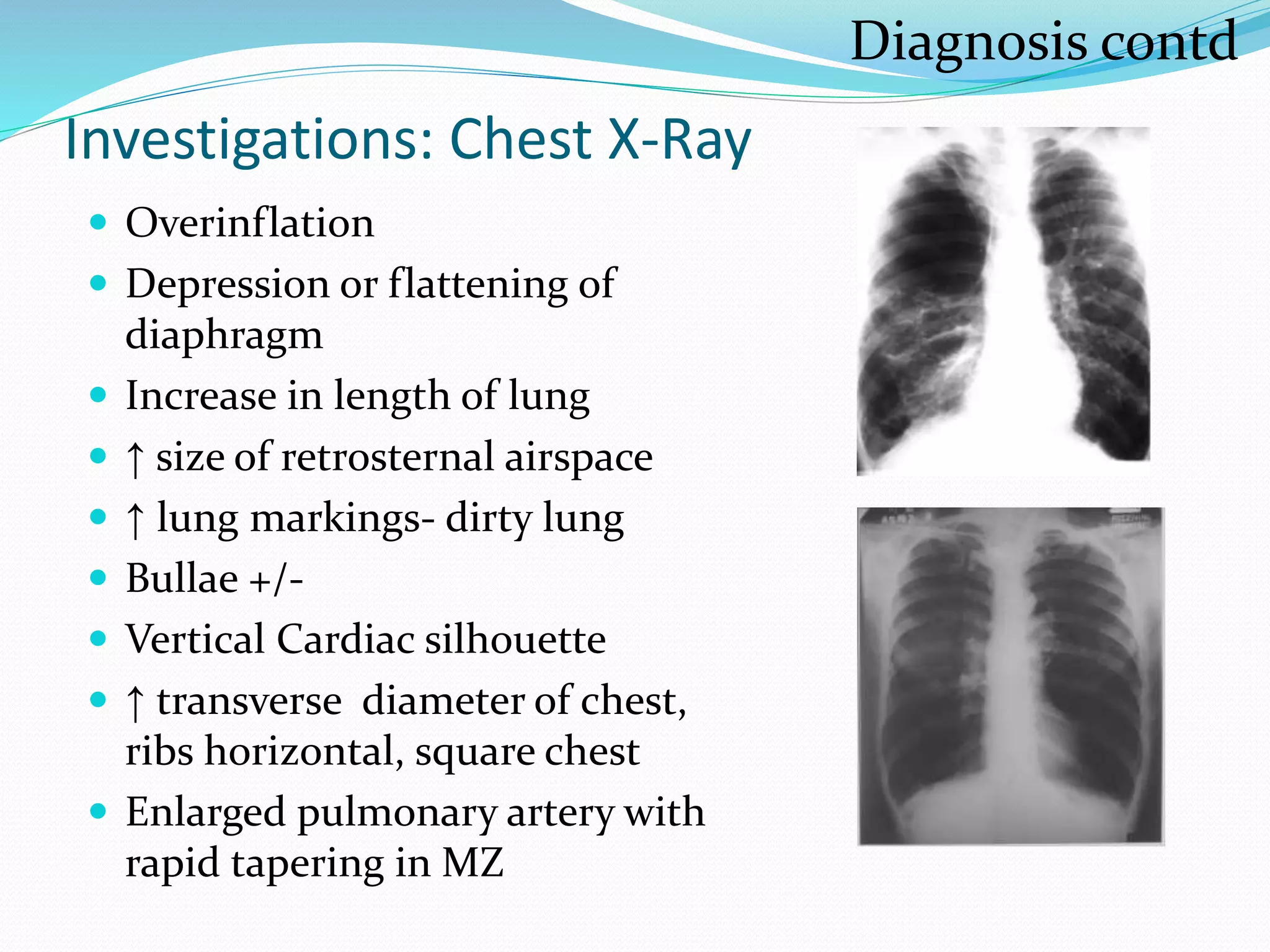 Investigations: Chest X-Ray
 Overinflation
 Depression or flattening of
diaphragm
 Increase in length of lung
 ↑ size of retrosternal airspace
 ↑ lung markings- dirty lung
 Bullae +/-
 Vertical Cardiac silhouette
 ↑ transverse diameter of chest,
ribs horizontal, square chest
 Enlarged pulmonary artery with
rapid tapering in MZ
Diagnosis contd
 