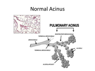 Normal Acinus
 