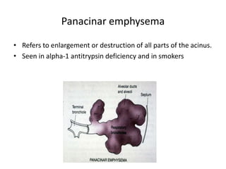 Panacinar emphysema
• Refers to enlargement or destruction of all parts of the acinus.
• Seen in alpha-1 antitrypsin deficiency and in smokers
 