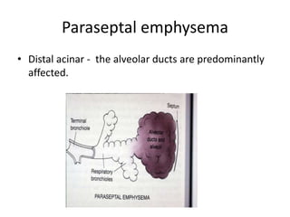 Paraseptal emphysema
• Distal acinar - the alveolar ducts are predominantly
affected.
 