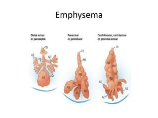 Emphysema
 