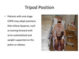 Tripod Position
• Patients with end-stage
COPD may adopt positions
that relieve dyspnea, such
as leaning forward with
arms outstretched and
weight supported on the
palms or elbows.
 