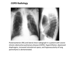 Posteroanterior (PA) and lateral chest radiograph in a patient with severe
chronic obstructive pulmonary disease (COPD). Hyperinflation, depressed
diaphragms, increased retrosternal space, and hypovascularity of lung
parenchyma is demonstrated.
COPD Radiology
 