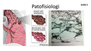 SLIDE 5
Patofisiologi
  Normal




  PPOK
 