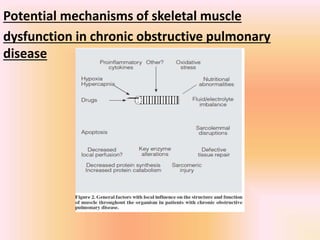 Potential mechanisms of skeletal muscle
dysfunction in chronic obstructive pulmonary
disease
 