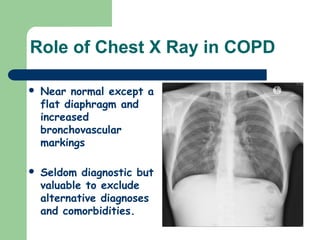 Role of Chest X Ray in COPD
 Near normal except a
flat diaphragm and
increased
bronchovascular
markings
 Seldom diagnostic but
valuable to exclude
alternative diagnoses
and comorbidities.
 