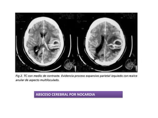 ABSCESO CEREBRAL POR NOCARDIA
 