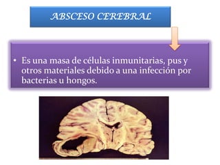 ABSCESO CEREBRAL




• Es una masa de células inmunitarias, pus y
  otros materiales debido a una infección por
  bacterias u hongos.
 
