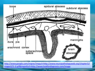 http://www.google.com/imgres?imgurl=http://www.neuropathologyweb.org/chapter5/i
mages5/5-1l.gif&imgrefurl=http://www.lookfordiagnosis.com/image
 