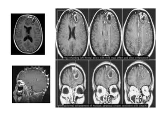 Absceso cerebral y Empiema subdural