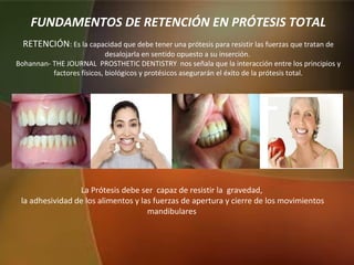 FUNDAMENTOS DE RETENCIÓN EN PRÓTESIS TOTAL
La Prótesis debe ser capaz de resistir la gravedad,
la adhesividad de los alimentos y las fuerzas de apertura y cierre de los movimientos
mandibulares
RETENCIÓN: Es la capacidad que debe tener una prótesis para resistir las fuerzas que tratan de
desalojarla en sentido opuesto a su inserción.
Bohannan- THE JOURNAL PROSTHETIC DENTISTRY nos señala que la interacción entre los principios y
factores físicos, biológicos y protésicos asegurarán el éxito de la prótesis total.
 