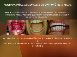 FUNDAMENTOS DE SOPORTE DE UNA PRÓTESIS TOTAL
SOPORTE : ES LA RESISTENCIA QUE DEBE POSEER UNA PRÓTESIS A LAS FUERZAS
INTRUSIVAS Y TODAS AQUELLAS QUE INCIDAN VERTICALMENTE EN DIRECCIÓN A
LA SUPERFICIE DE ASIENTO .
LA CAPACIDAD DEL TERRENO PROTÉSICO QUE CUMPLA SU MISIÓN DE APOYO
Ó
DE RESISTENCIA MECÁNICA Y BIOLOGICAMENTE LA ACCIÓN DE LA PRÓTESIS
EN FUNCIÓN
 