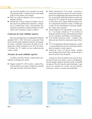 816 Ortodontia e Ortopedia Funcional dos Maxilares – Miniconferências
são mais bem tratadas com a mecânica seccional.
No paciente adulto, a redução da alta convexidade
pode ser feita apenas com cirurgia.
Pode ser usada na dentição mista ou mesmo na
dentição decídua.
Permite que as forças naturais da língua e dos lá-
bios atuem nos apinhamentos anteriores, corrigin-
do-os à medida que ocorre o deslocamento dos
segmentos posteriores, proporcionando um trata-
mento mais confortável, seguro e estético.
Confecção da seção utilidade superior
Para sua construção deve ser empregado fio Elgiloy
quadrado .016" x .016". O fio deve ser passado 4 mm
acima do tubo molar, medido em direção ao braquete
do canino, e dobrado 4 mm abaixo de onde ele é do-
brado para a frente, entrando no slot .018" do canino.
O formato em “Z” confere ao arco melhor pressão
contra o molar.
Ativações da seção utilidade superior
As dobras são feitas mesiais ao tubo molar e dis-
talmente ao braquete do canino:
Ângulo caudal 15º a 20º no molar – produz 50 g.
de força intrusiva no canino, evitando sua extrusão
pela ação da tração vertical do elástico.
Dobra rotacional de 15º no molar – posiciona o
canino para lingual no interior do canal cortical e
previne seu alargamento pela tração lateral do elás-
tico.A prescrição de Ricketts fornece um tubo com
rotação de 15º, contudo 10° pode ser adicionado,
se necessário. Essa rotação também protege con-
tra o alargamento lateral do canino, à medida que
o molar se move distalmente e rotaciona, atingin-
do a seção como um todo.
Torque lingual de 10º adicionados à raiz do cani-
no – esse torque somado aos 7º já contidos no
braquete mantém sua raiz direcionada para dentro
do osso esponjoso, facilitando a movimentação.
5º de rotação mesial do canino – combate a ten-
dência de giro distal do canino pela tração elásti-
ca.
5º a 7º de angulação radicular distal para o canino
– evita inclinação da coroa do canino para distal e
intrui levemente o molar superior.
Avanço de 1 mm a 1,5 mm no canino – garante
uma contínua força distal sobre o molar até que a
ação do elástico seja alcançada.
A tração de 150 g do elástico terá cerca de 50 g.
de efeito extrusivo no canino, o que é contrabalança-
do pelo ângulo caudal no primeiro molar, resultando
em apenas 100 g de força de ação distalizante, o que
provou ser suficiente no “arrasto” dos pré-molares,
assim que o molar e o canino são distalizados.
Fig. 2Fig. 1
 