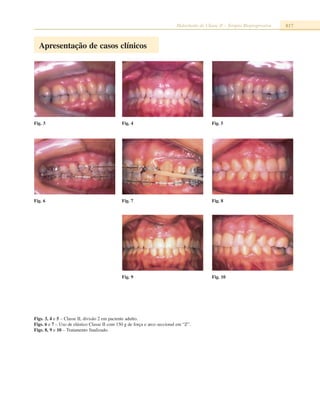 Maloclusão de Classe II – Terapia Bioprogressiva 817
Fig. 4Fig. 3 Fig. 5
Fig. 7Fig. 6 Fig. 8
Apresentação de casos clínicos
Fig. 9 Fig. 10
Figs. 3, 4 e 5 – Classe II, divisão 2 em paciente adulto.
Figs. 6 e 7 – Uso de elástico Classe II com 150 g de força e arco seccional em “Z”.
Figs. 8, 9 e 10 – Tratamento finalizado.
 