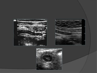 Comprehensive Overview of Acute Appendicitis: Anatomy, Diagnosis, and ...