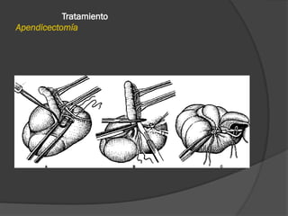 Comprehensive Overview of Acute Appendicitis: Anatomy, Diagnosis, and ...