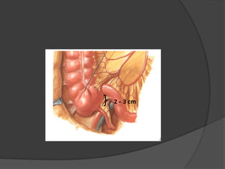 Comprehensive Overview of Acute Appendicitis: Anatomy, Diagnosis, and ...