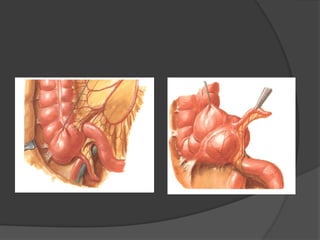 Comprehensive Overview of Acute Appendicitis: Anatomy, Diagnosis, and ...