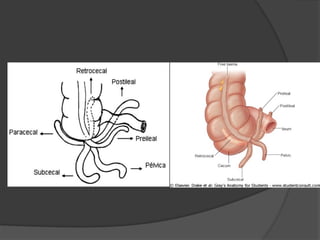 Comprehensive Overview of Acute Appendicitis: Anatomy, Diagnosis, and ...