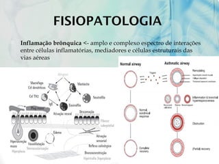 FISIOPATOLOGIA
 Inflamação brônquica <- amplo e complexo espectro de interações
entre células inflamatórias, mediadores e células estruturais das
vias aéreas.
 