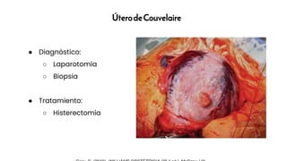 ÚterodeCouvelaire
● Diagnóstico:
○ Laparotomía
○ Biopsia
● Tratamiento:
○ Histerectomía
 